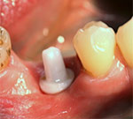 Dental Implants show cases