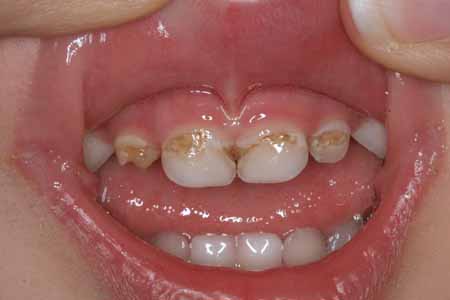 Cavities 1