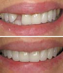 zirconia tooth implant